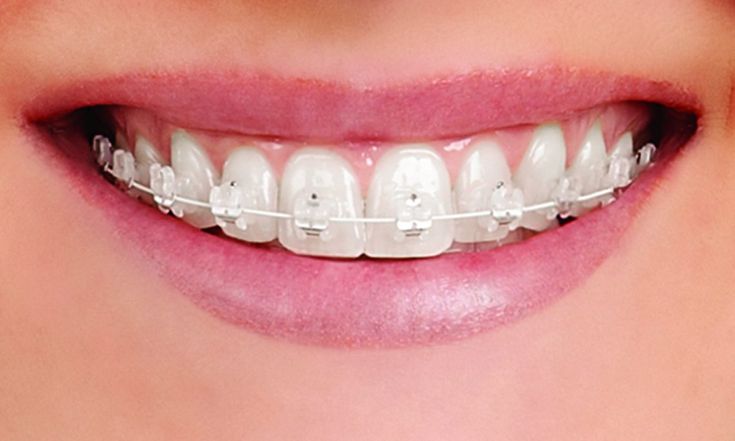 Best Orthodontic Treatment in Hyderabad